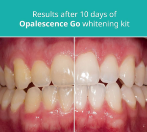 Opalescence 10 day comparison results teeth whitening kit