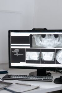 x rays in dental veneers procedure