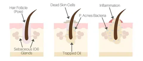 acne formation from clogged pores infographic diagram