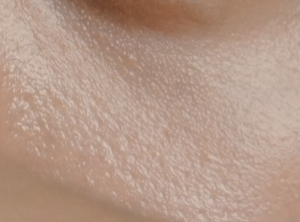 10 Best Ingredients For Oily Acne Prone Skin to Know - The Redefined ...