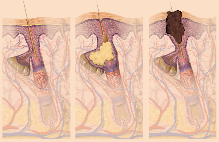 infographic showing how sunscreen clogs pores