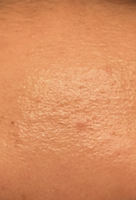 photo of oily skin